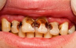 Sâu răng là một trong những nguyên nhân gây hôi miệng điển hình
