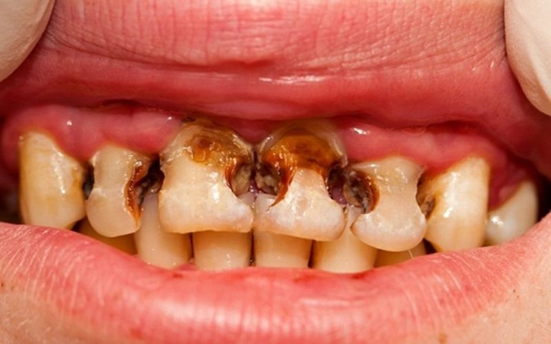 Sâu răng là một trong những nguyên nhân gây hôi miệng điển hình