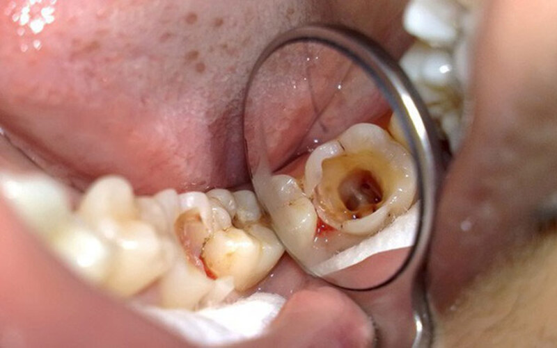 Những trường hợp bị sâu răng hàm sẽ gây ra tình trạng đau răng, rụng răng hoặc thậm chí nhiễm trùng