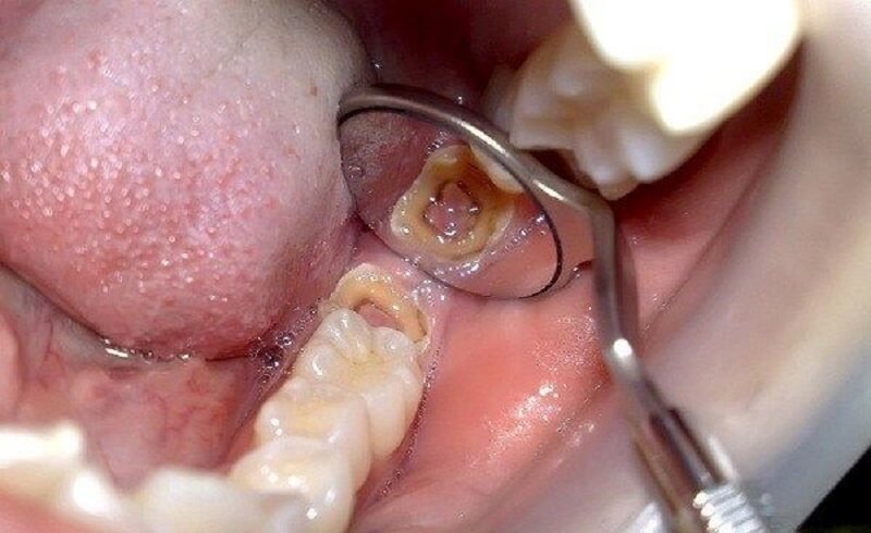 Sâu răng nổi hạch không điều trị kịp thời gây ra viêm nhiễm xương hàm