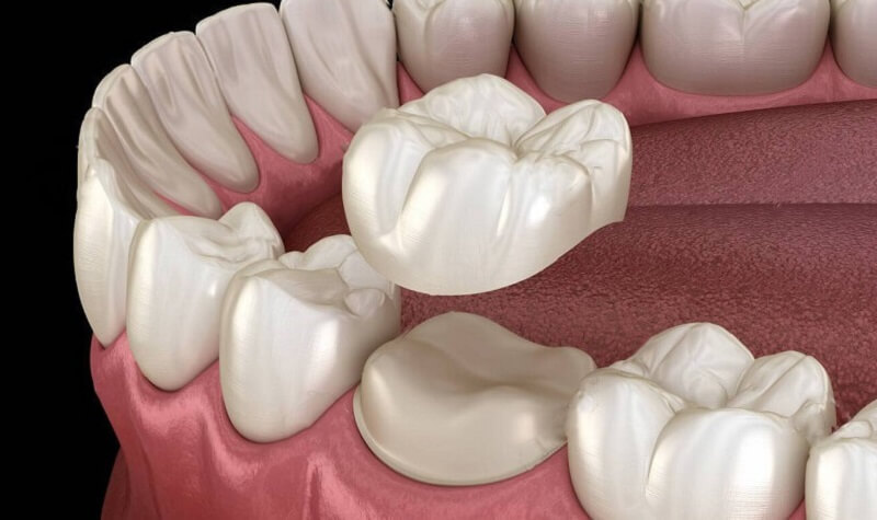 Thực hiện bọc răng sứ cho bệnh nhân bị sâu răng nặng