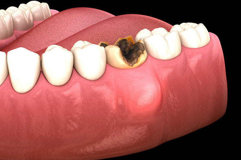 Áp xe răng là tình trạng biến chứng nặng do sâu răng có mủ không được điều trị kịp thời