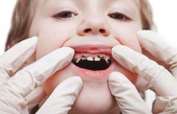 Sâu răng trẻ em - Nguyên nhân, Biểu hiện và cách điều trị