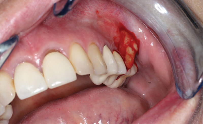 Khi nướu răng bị viêm nhiễm sẽ có những biểu hiện khác nhau tùy theo thể trạng từng người