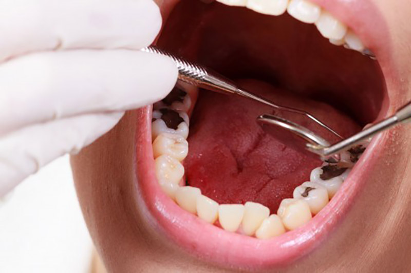 Trường hợp bị sâu răng nặng, bạn cần tìm đến sự can thiệp của y khoa