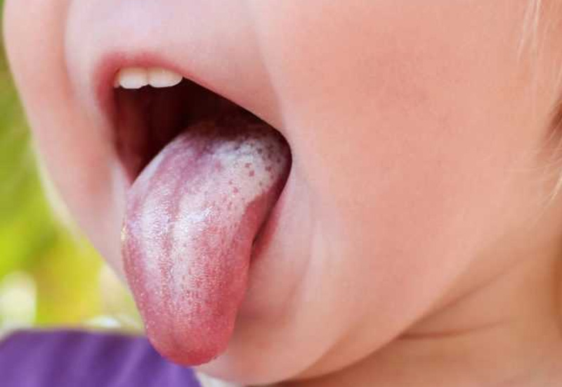 Ở giai đoạn đầu, triệu chứng dễ nhận biết nhất là những chấm trắng hình thành trên đầu lưỡi 
