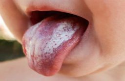 Tưa miệng là bệnh gì? Cách chữa trị hiệu quả nhất