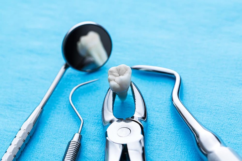 Nhổ răng số 8 là giải pháp điều trị viêm lợi trùm cuối cùng