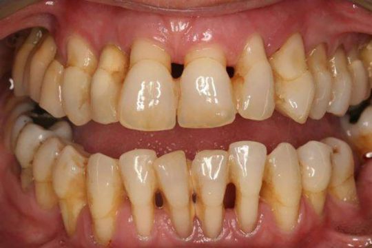 Nguyên nhân chính gây viêm nha chu mãn tính là do không biết cách chăm sóc răng miệng