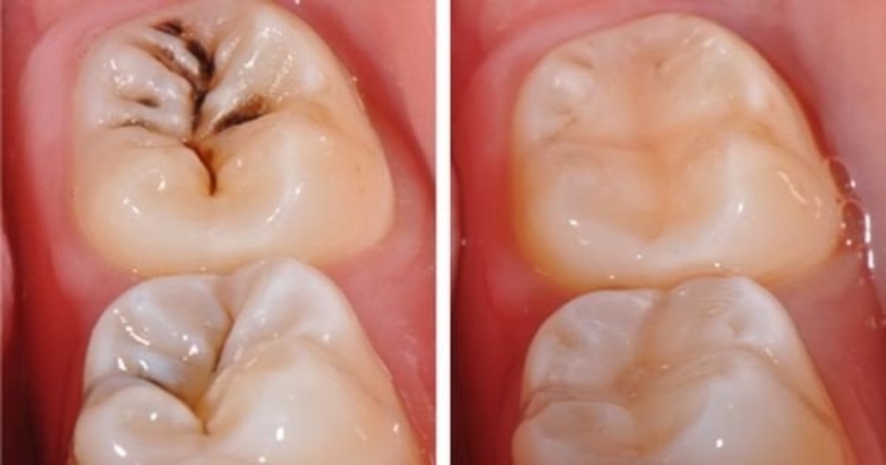 Trám răng là phương pháp khá đơn giản nhưng cần độ chính xác cao