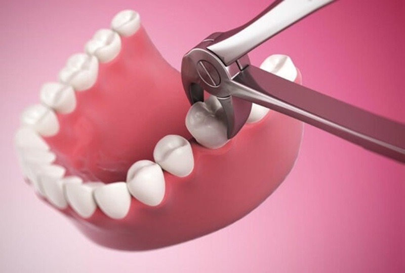 Nhổ răng sâu được xem là phương pháp cuối cùng khi người bệnh bị sâu răng nặng