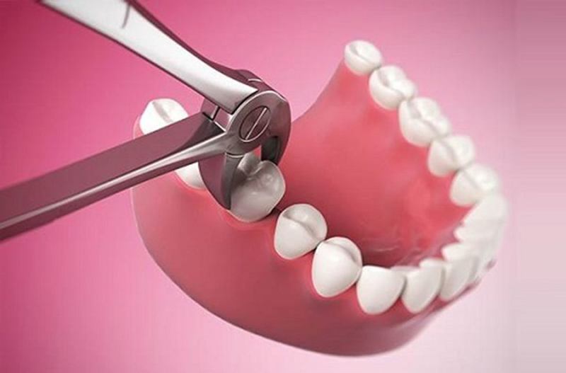 Quy trình nhổ răng số 6 phải được đảm bảo an toàn tuyệt đối.