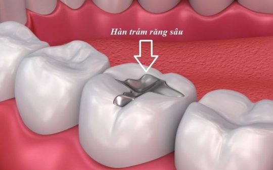 Trám răng sâu sử dụng chất liệu nha khoa chuyên dụng