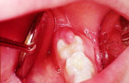 Sưng nướu răng khôn - Nguyên nhân, biểu hiện và cách khắc phục