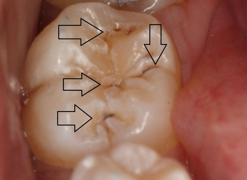 Trám bít hố rãnh răng sâu giúp ngăn ngừa sâu răng.