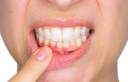Viêm nướu răng - Nguyên nhân, biểu hiện và cách khắc phục