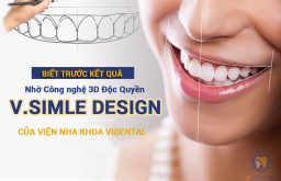 Công nghệ Thiết kế nụ cười V.Smile Design tại ViDental