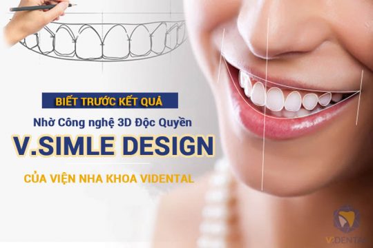 Công nghệ Thiết kế nụ cười V.Smile Design tại Vidental