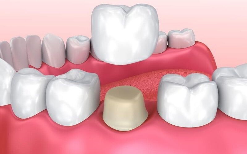 Mão răng sứ khá phù hợp với những trường hợp tổn thương trên 1 răng