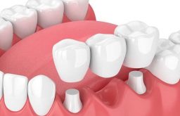 Nếu bị mất 1 hoặc nhiều răng, có thể bạn sẽ phù hợp với cấu răng sứ