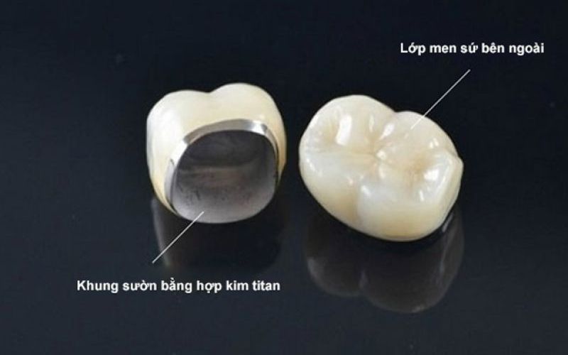 Răng sứ kim loại có phần sườn bên trong bằng chất liệu kim loại