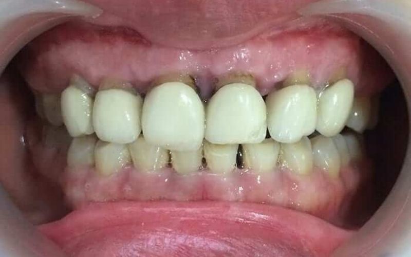 Bọc răng sứ có thể mang lại hàm răng thẩm mỹ nhưng cũng tiềm ẩn một vài rủi ro nhất định
