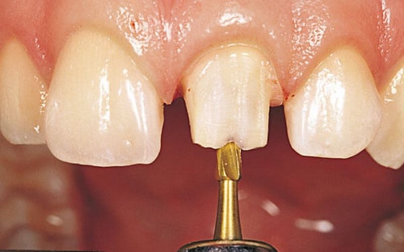 Quy trình thực hiện bọc sứ tại nha khoa giúp bạn có được một hàm răng như ý