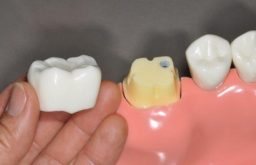 Tùy vào chất liệu răng mà mức giá bọc răng sứ cho răng sâu cũng khác nhau