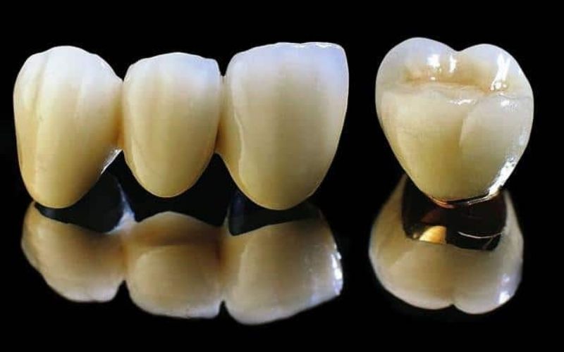 Răng sứ kim loại thường có giá thành thấp, phù hợp với nhiều đối tượng