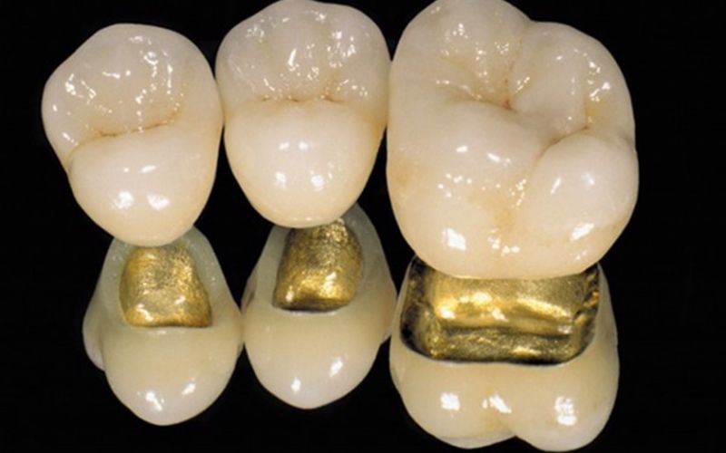 Nên bọc răng sứ loại nào? Lựa chọn loại răng dành cho giới thượng lưu, quý tộc