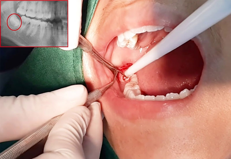 Hình ảnh bác sĩ tiến hành nhổ răng số 8 bị sâu vỡ