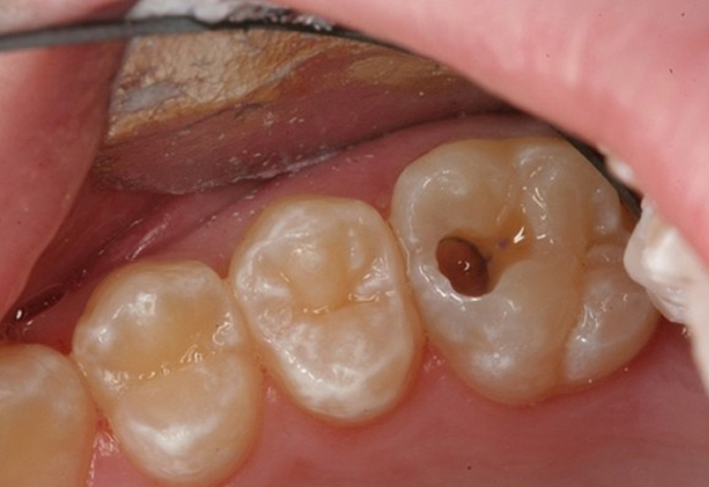 Răng số 8 bị sâu vỡ gây ra rất nhiều tác động xấu cho sức khỏe răng miệng