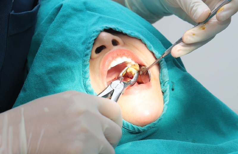 Nên nhổ bỏ răng số 8 để tránh các biến chứng về sau