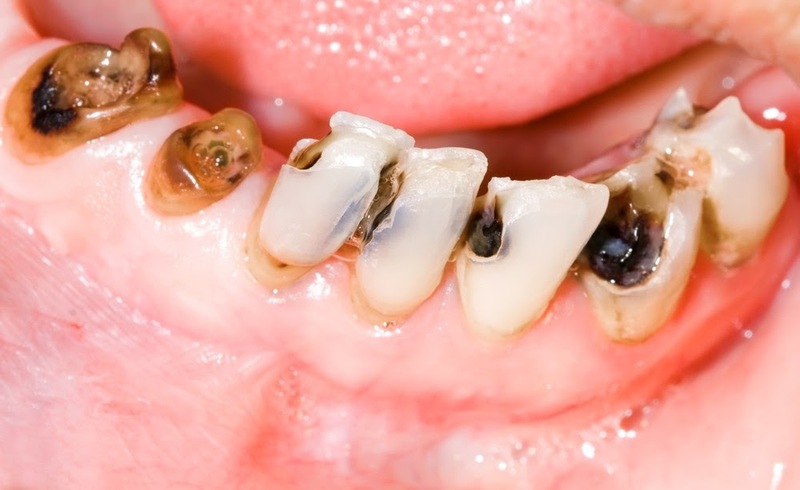 Có nhiều nguyên nhân khiến răng cửa bị sâu