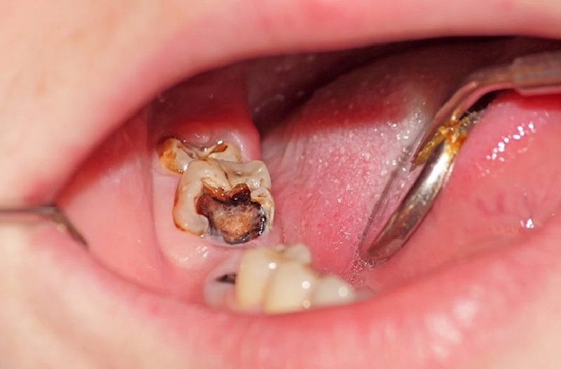 Sâu răng có gây ung thư không? Câu trả lời là có