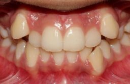 bọc răng sứ cho răng khểnh