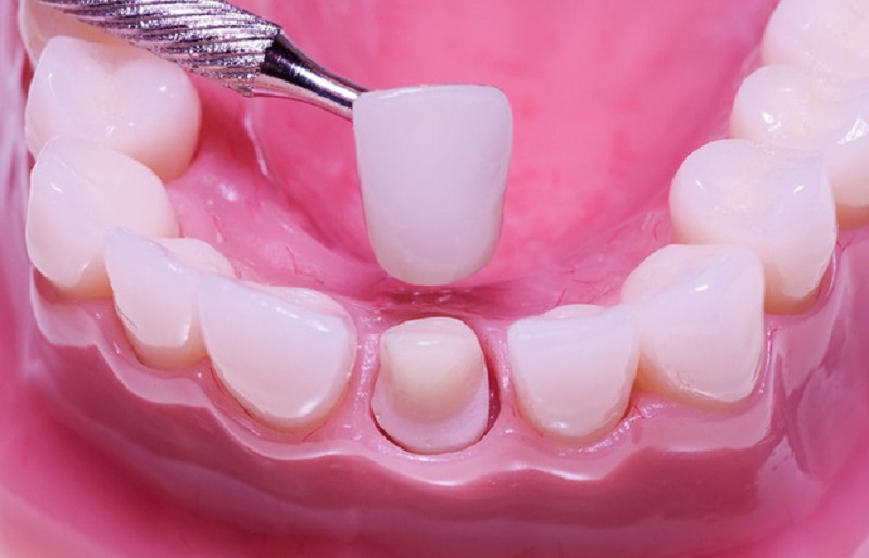Bọc sứ răng cửa giúp khắc phục hiệu quả tình trạng răng của mọc thưa, sứt mẻ hay xỉn màu