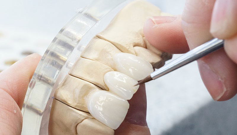 Quy trình chế tác răng sứ tại ViDental theo 4 bước tiêu chuẩn