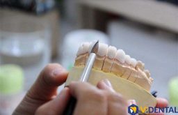 Chế tác răng sứ số 1 hàng đầu tại Việt Nam