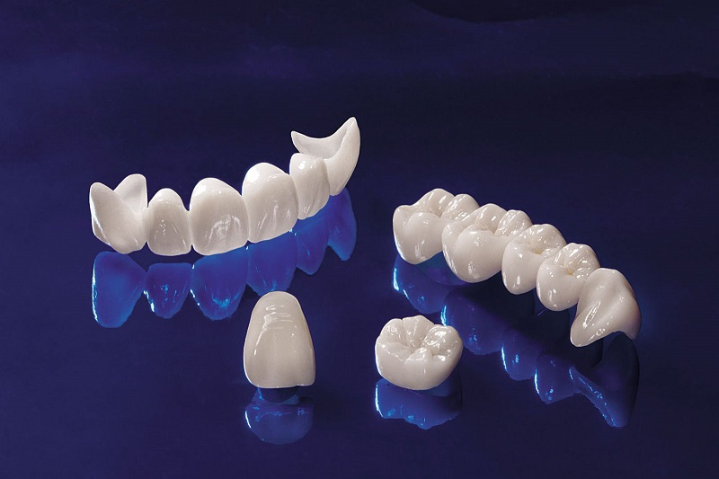Bọc răng sứ Cercon được xem là xu hướng nha khoa thẩm mỹ thịnh hành nhất hiện tại