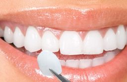 Bọc răng sứ cho răng hô có thật sự hiệu quả không? Giá bao nhiêu?