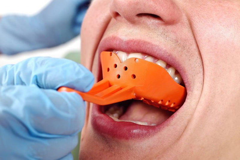 Công đoạn lấy dấu hàm trong quy trình bọc răng sứ