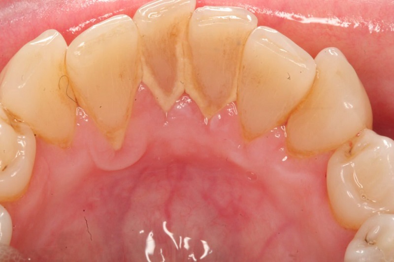 Trên thực tế, hiện nay vẫn có rất nhiều người không biết cao răng là gì.