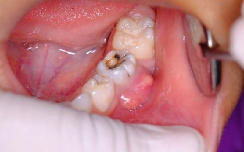 Các bạn cần chú ý chăm sóc răng miệng đúng cách tránh để bị sâu