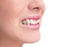 Răng khểnh là gì? Có nên niềng răng khểnh không? [Giải đáp ngay]