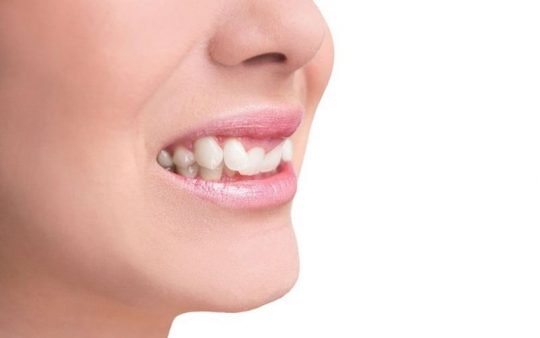 Răng khểnh là gì? Có nên niềng răng khểnh không? [Giải đáp ngay]