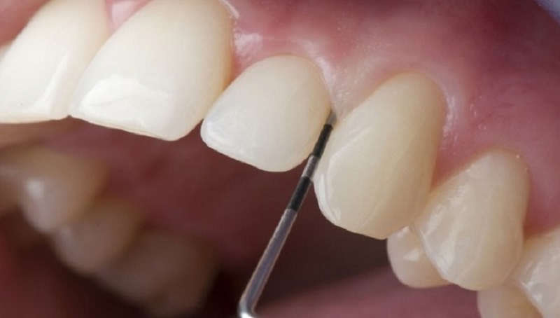 Bước mài men răng trong quy trình dán răng sứ 