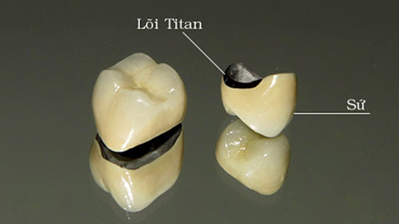 Loại răng này có lớp kim loại/titan ở bên trong, còn bên ngoài là sứ