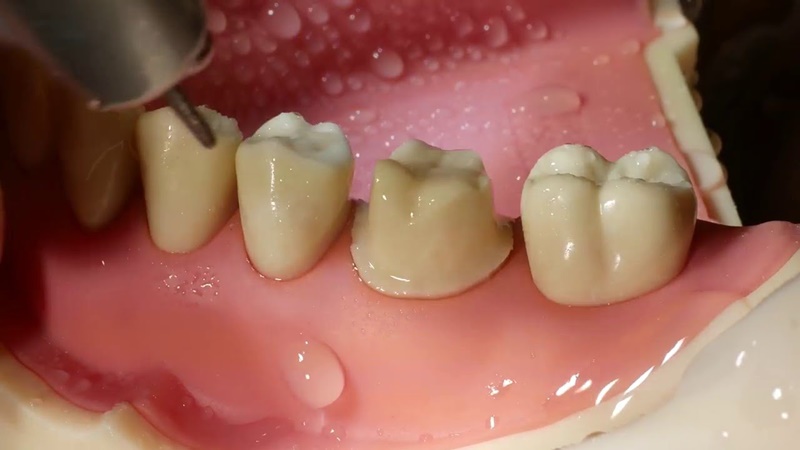 Kĩ thuật mài cùi răng sẽ quyết định đến độ bền của răng