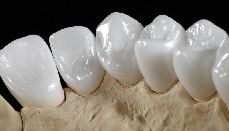 Răng sứ có độ bền cao và đem lại tính thẩm mỹ